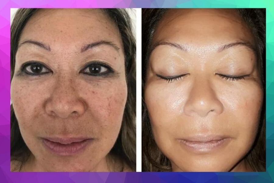 Before and after gallery result