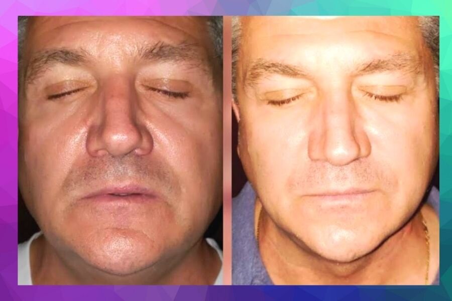 Before and after gallery result