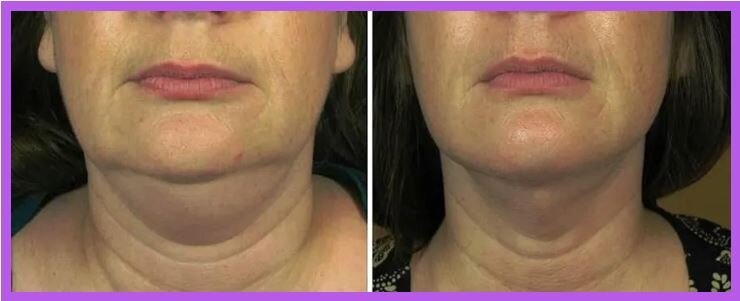 Face and neck before and after